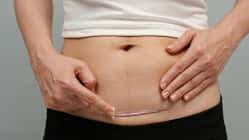 So unterstützt du die Heilung deiner Kaiserschnittnarbe