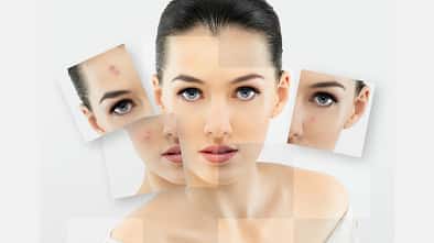 Alles über unreine Haut