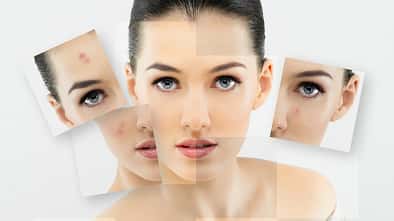 Alles über unreine Haut