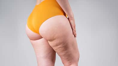 Cellulite - was hilft? / Staras / Getty Images