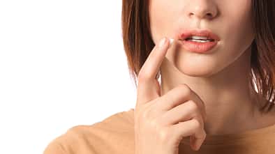 Bereits bei den ersten Anzeichen eines Lippenherpes sollte man schnell handeln