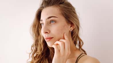 A,Young,Woman,With,Bad,Skin.,Skin,With,A,Lot