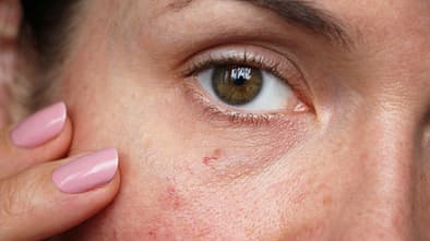 Ständig rote Haut? Pflege-Tipps für Rosazea