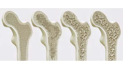 Osteoporose Die verschiedenen Stadien der Osteoporose