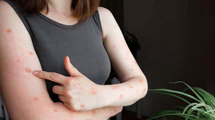 Mpox, Affenpocken, Monkeypox Mpox-Pocken enthalten eine hochansteckende Flüssigkeit