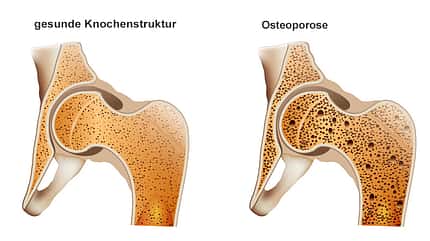Ist ein zu hoher Milchkonsum wirklich eine Ursache von Osteoporose? Ist ein zu hoher Milchkonsum wirklich eine Ursache von Osteoporose?