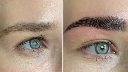 Brow-Lift im Vorher-Nachher-Vergleich Brow-Lift im Vorher-Nachher-Vergleich