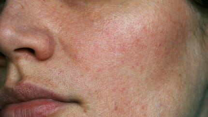 Rosazea-Pflege: Das hilft bei roter Haut Rosazea-Pflege: Das hilft bei roter Haut