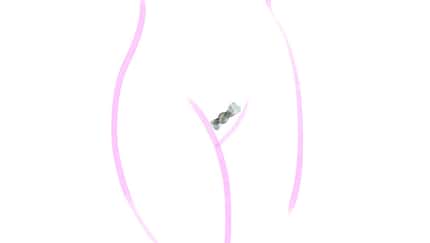 Intimrasur Schleife