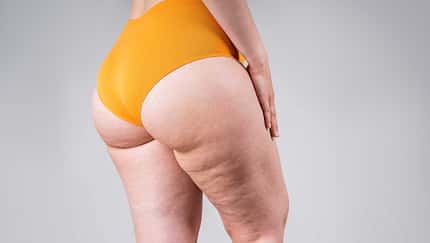 Cellulite - was hilft? / Staras / Getty Images