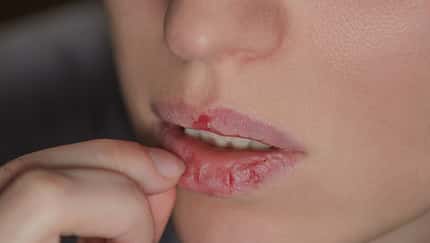 Vor allem das Gesicht, aber auch die Lippen sind häufig vom Skin Picking betroffen