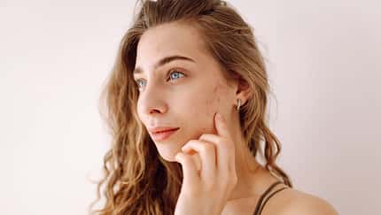 A,Young,Woman,With,Bad,Skin.,Skin,With,A,Lot