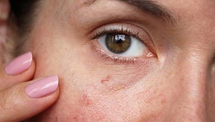 Ständig rote Haut? Pflege-Tipps für Rosazea