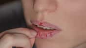 Vor allem das Gesicht, aber auch die Lippen sind häufig vom Skin Picking betroffen